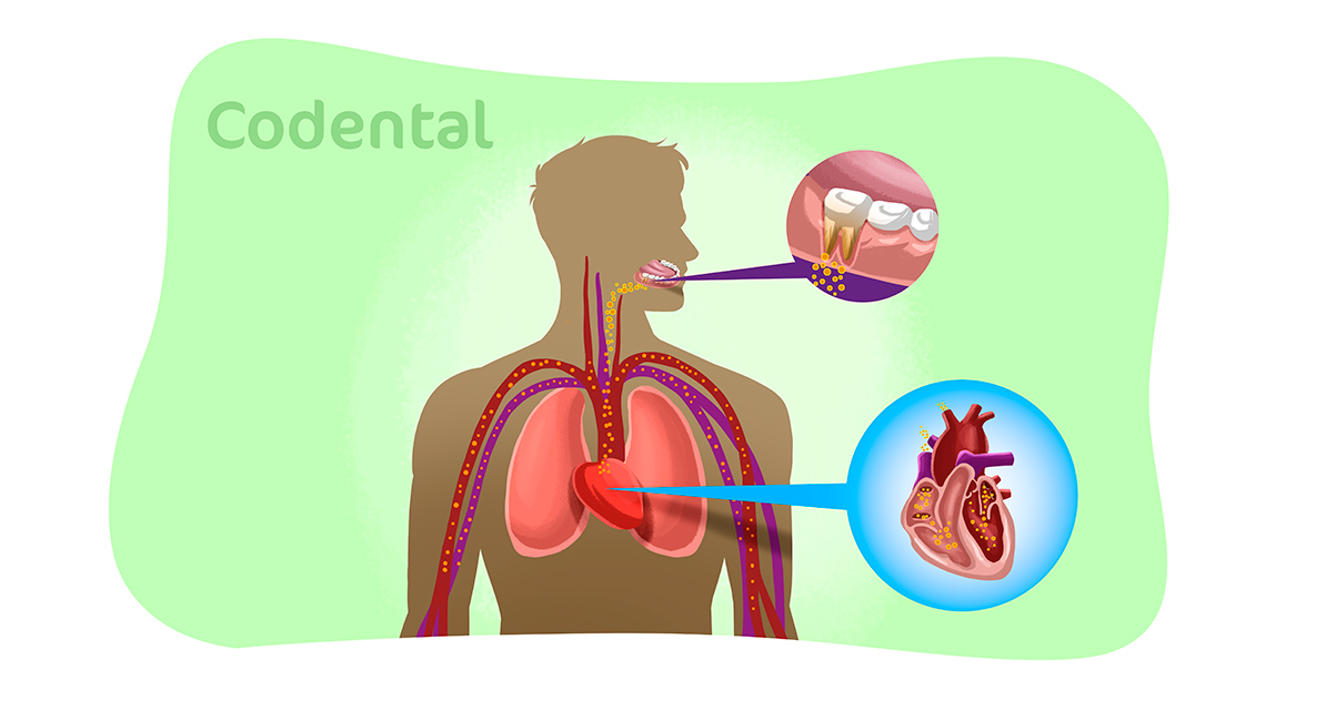 Endocardite bacteriana odontologia