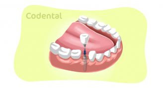 Implante dentário: tudo o que você precisa saber