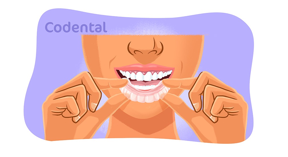 clareamento dental com moldeira