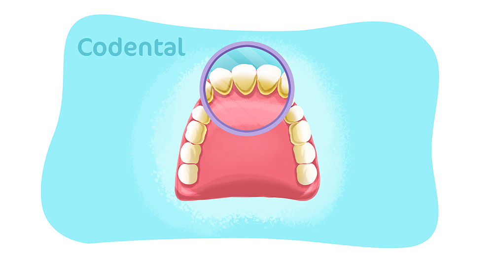 Calculo dental