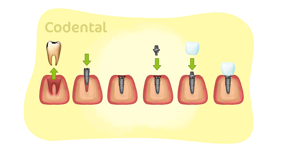 como é feito um implante dentário