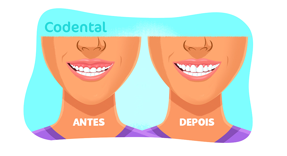 Gengivoplastia