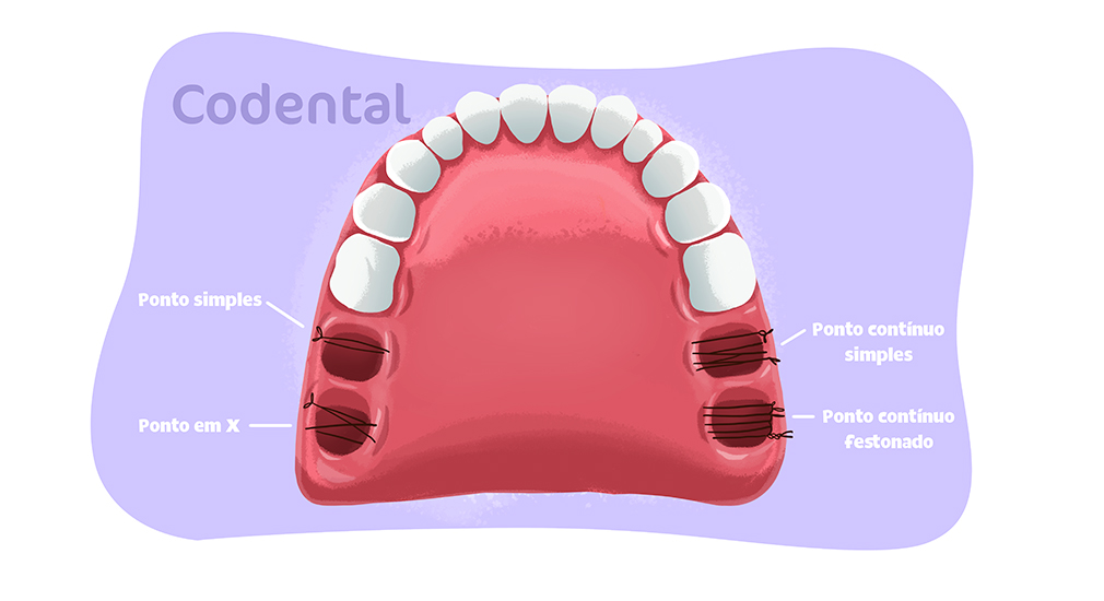 Tipos de sutura odontológica