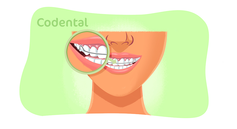 Contenção ortodontica