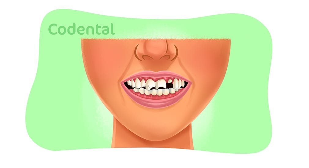 Dentes quebradiços
