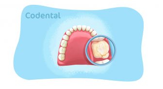 Infiltração no dente: tire todas as suas dúvidas