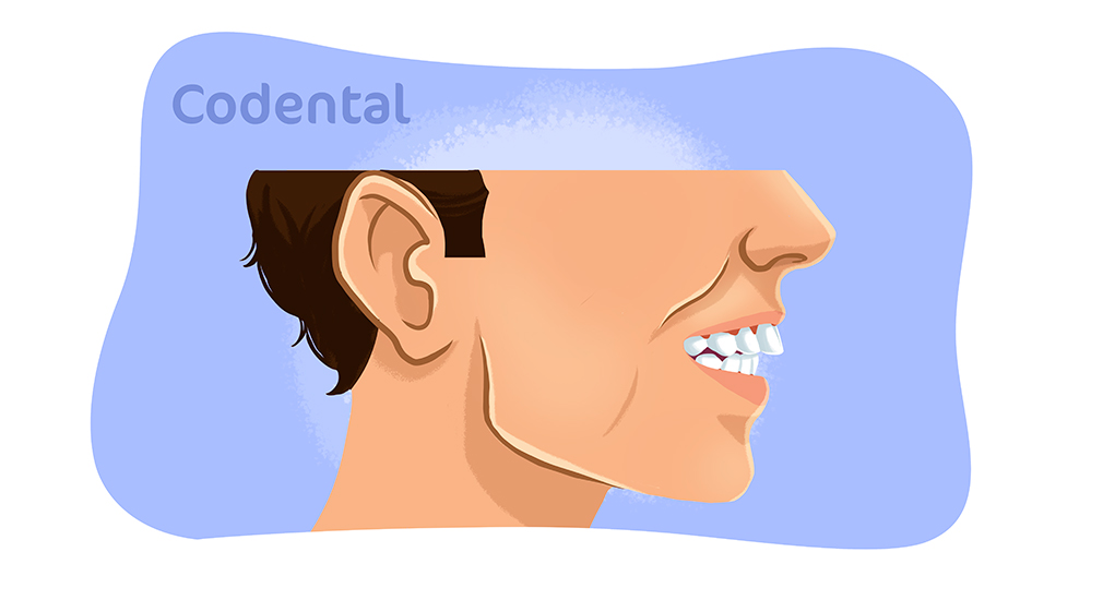 Mordida profunda: entenda o que é e como tratar