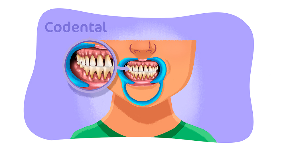 Perda óssea dentária