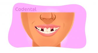 Agenesia dentária: saiba tudo sobre o problema