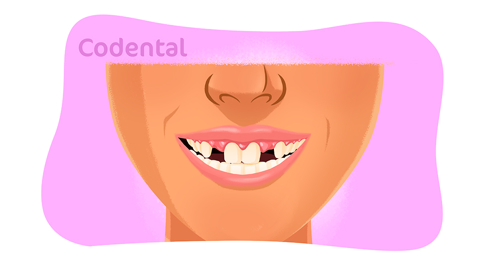 Agenesia dentaria