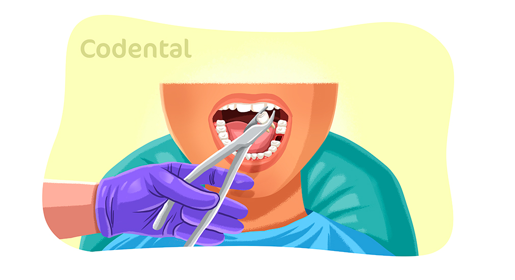 Extração de dente
