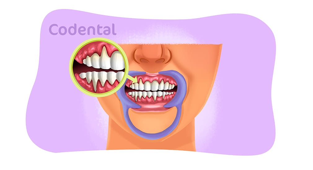 Retração gengival