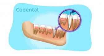 Medicação intracanal: saiba tudo sobre seu uso