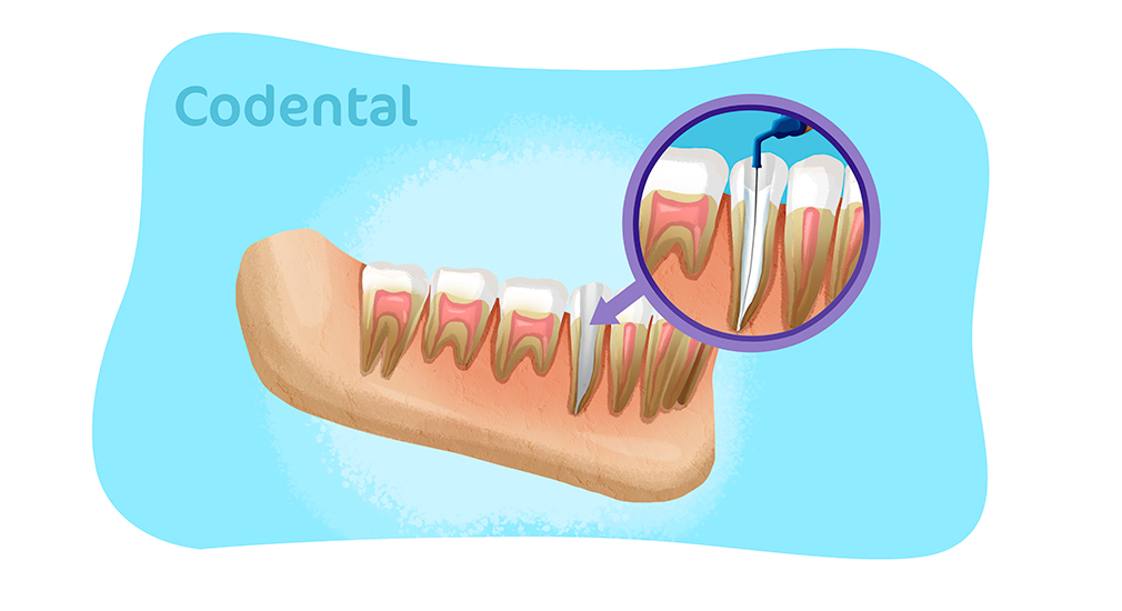 Medicação intracanal