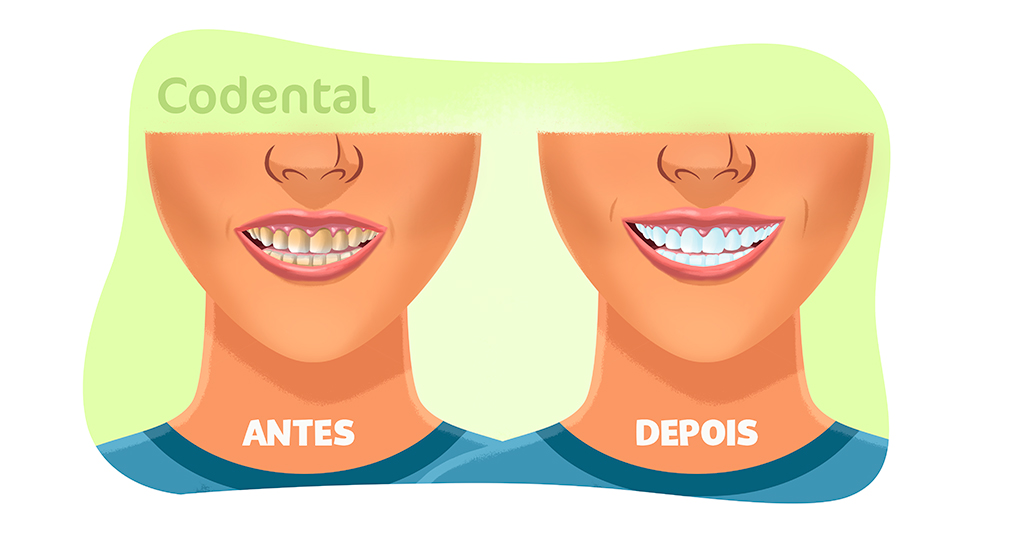 Clareamento dental