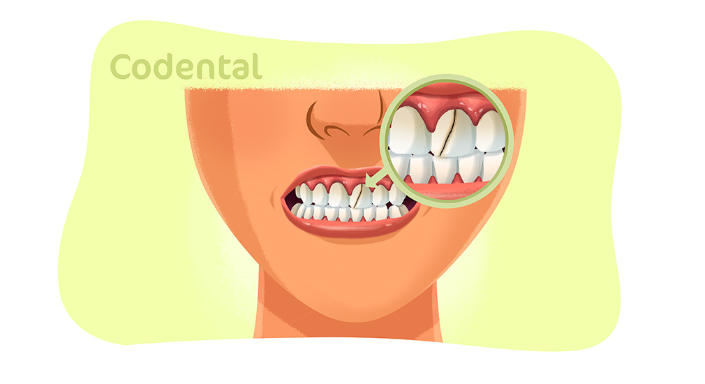 Dente trincado