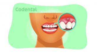 Bolinha na gengiva: como diagnosticar e tratar