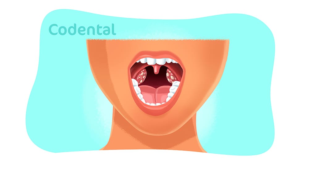 Cáseos: Conheça as bolinhas fedidas que aparecem na garganta