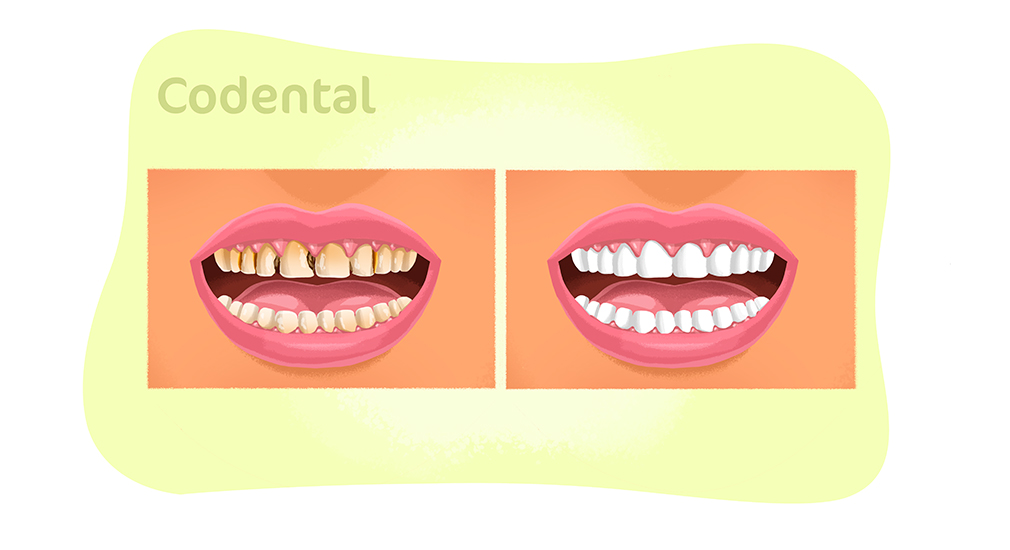 Restauração com resina nos dentes da frente