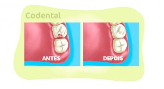 Restauração de dente: tudo sobre o procedimento