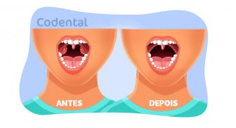 Amigdalectomia: saiba tudo sobre o procedimento