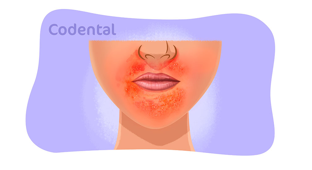 dermatite perioral