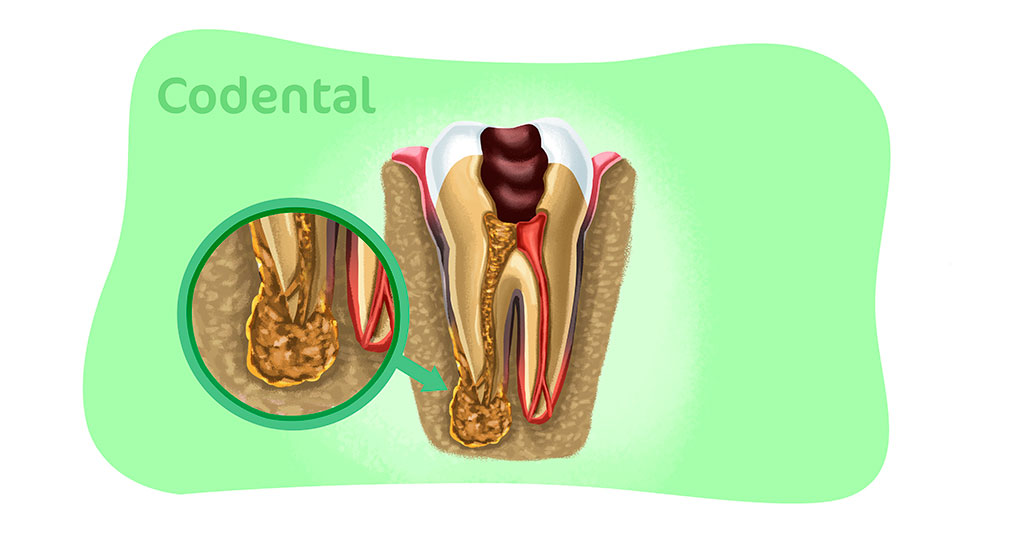 Lesao periapical