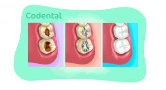 Obturação do dente: tudo que você precisa saber
