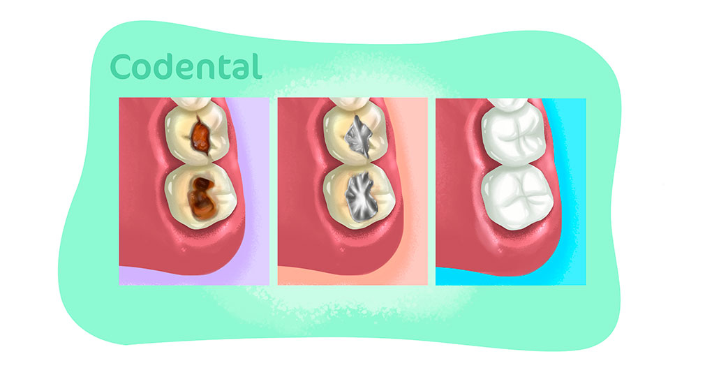 obturação do dente