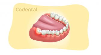 Pericoronarite: sintomas, tratamento e muito mais