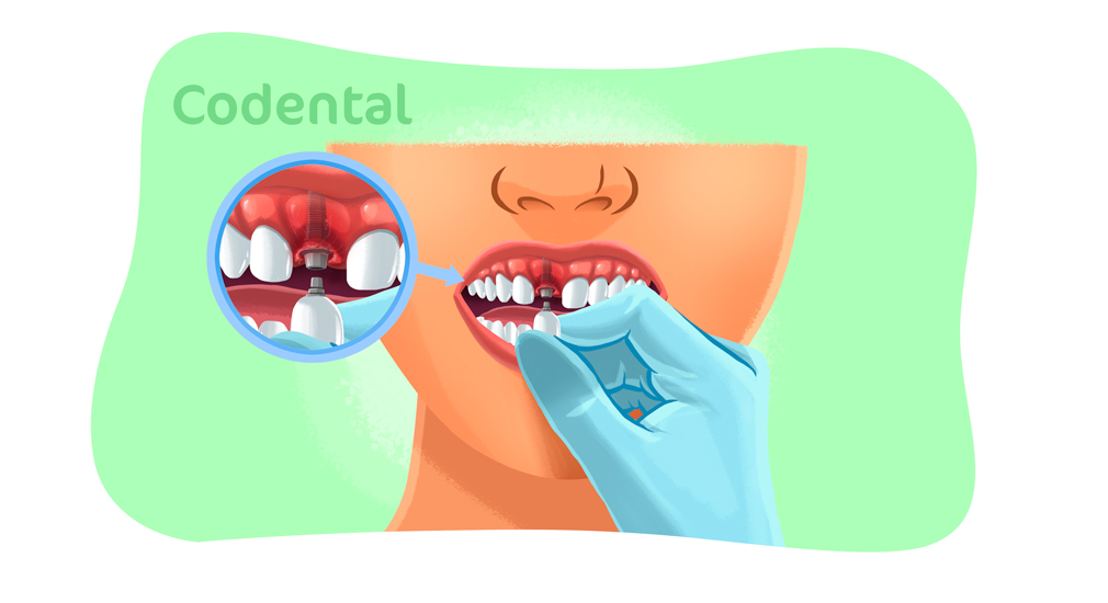 Sintomas de infecção no implante dentário