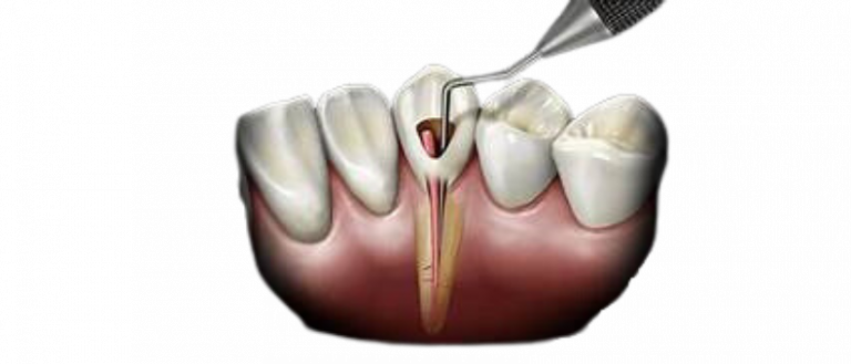 Obturação do dente: tudo que você precisa saber