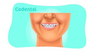 Aparelho ortodôntico: saiba tudo sobre o assunto