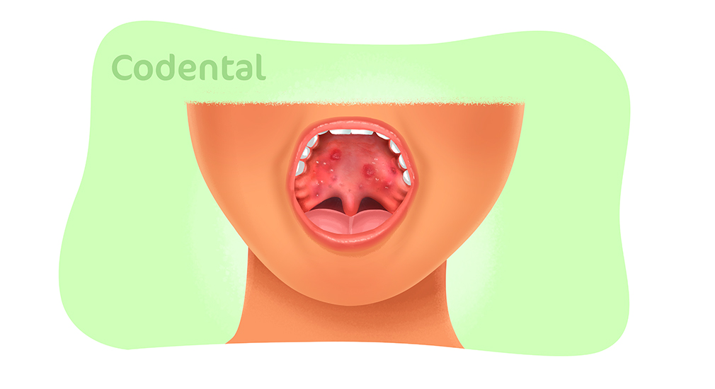 Afta na garganta: 7 principais causas (e o que fazer) - Tua Saúde