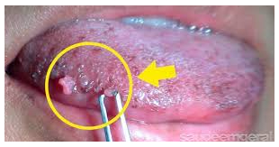 Lesão HPV na língua