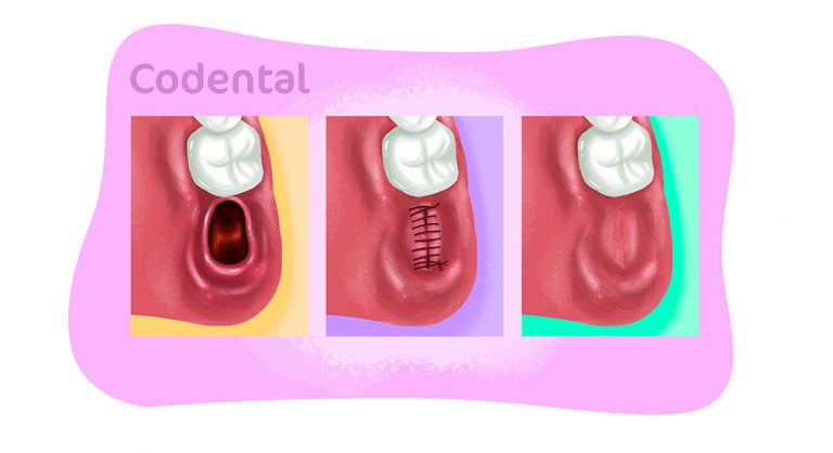 Cicatrização do siso: tudo que você precisa saber - Codental Blog