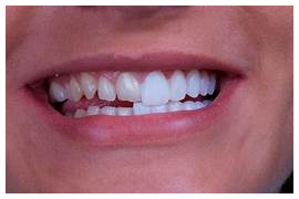 Antes e depois dentes de portcelana