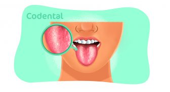 Sapinho na boca: causas, sintomas e muito mais