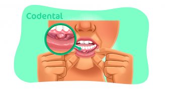 Cisto na boca: saiba mais sobre