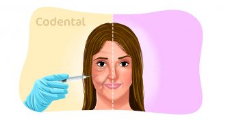 Preenchimento facial: tudo que você precisa saber!