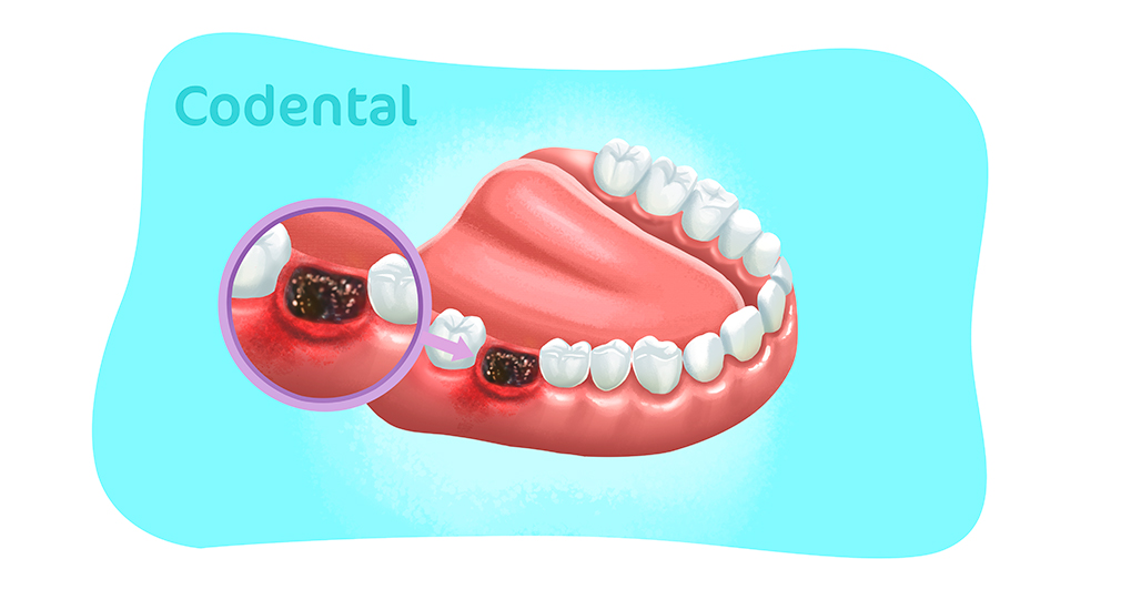 alveolite