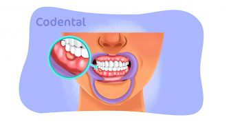 Pus na gengiva: tudo que você precisa saber