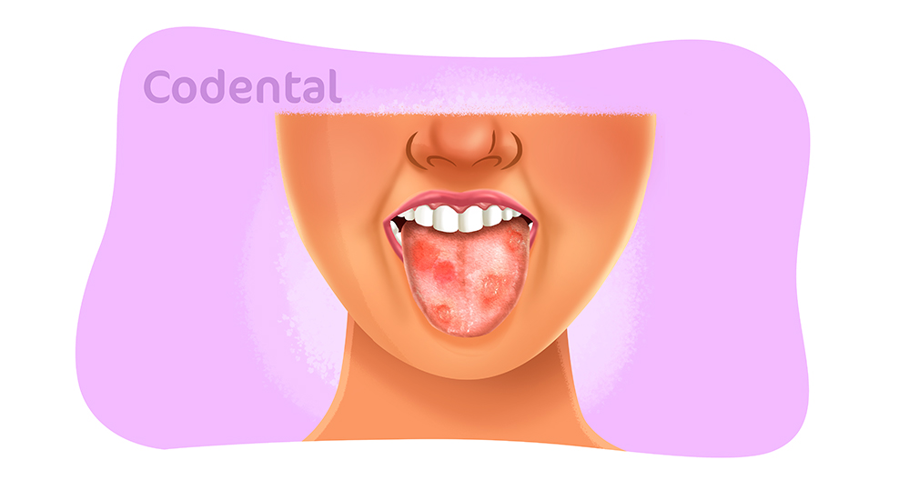 Afta na garganta: 7 principais causas (e o que fazer) - Tua Saúde