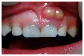 F stula Dental Entenda Tudo Sobre Essa Condi o F stula Dental Entenda Tudo Sobre Essa Condi o