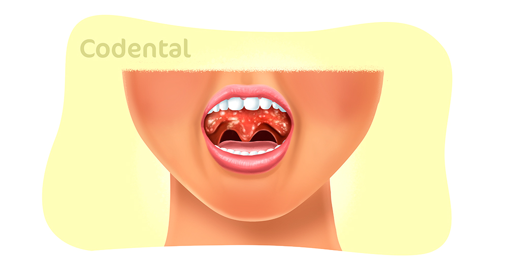 Herpangina: o que é, sintomas e tratamento - Tua Saúde