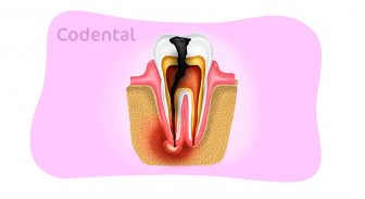 Dente infeccionado: saiba tudo sobre