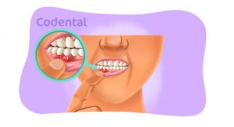 Fístula dental: entenda tudo sobre essa condição