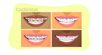 Tipos de aparelhos ortodônticos que você precisa conhecer