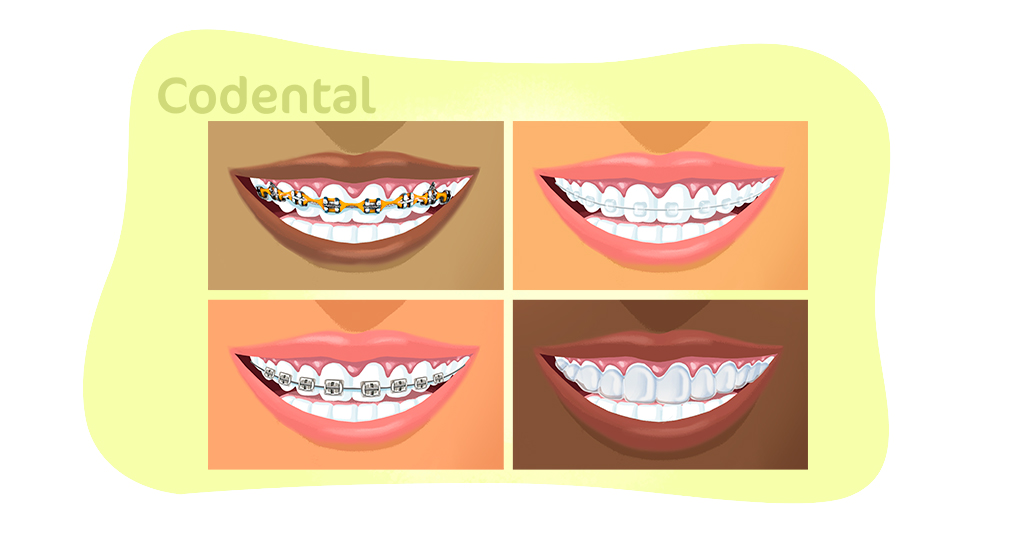 Tipos de aparelhos ortodônticos