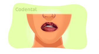 Necrose labial: o que é, sintomas, como evitar e muito mais!